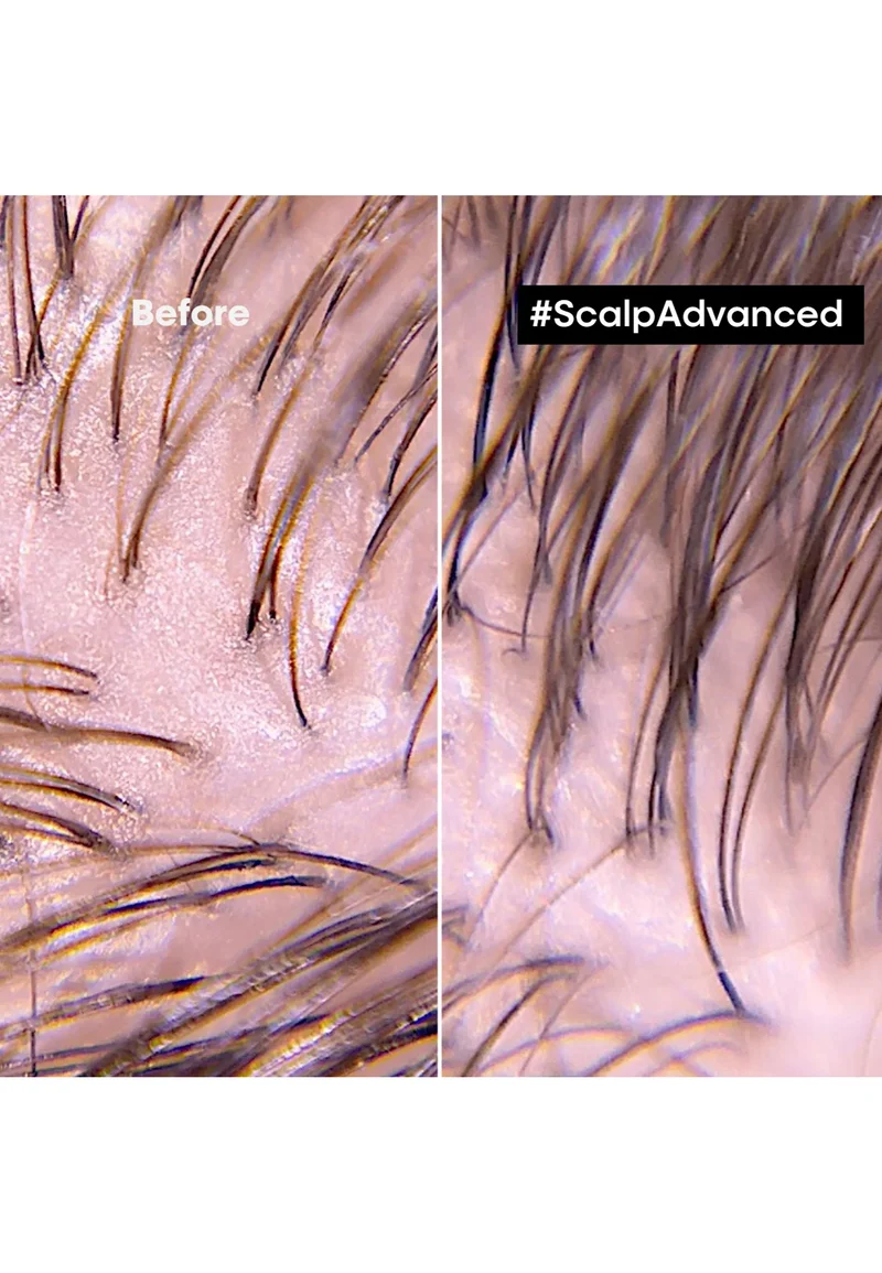 L'Oreal Professionnel- Scalp Advanced Maschera