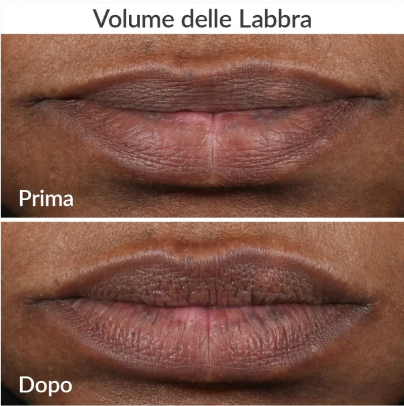 PMD Beauty Kiss Sistema Volume Labbra Anti-Age con Vacuum