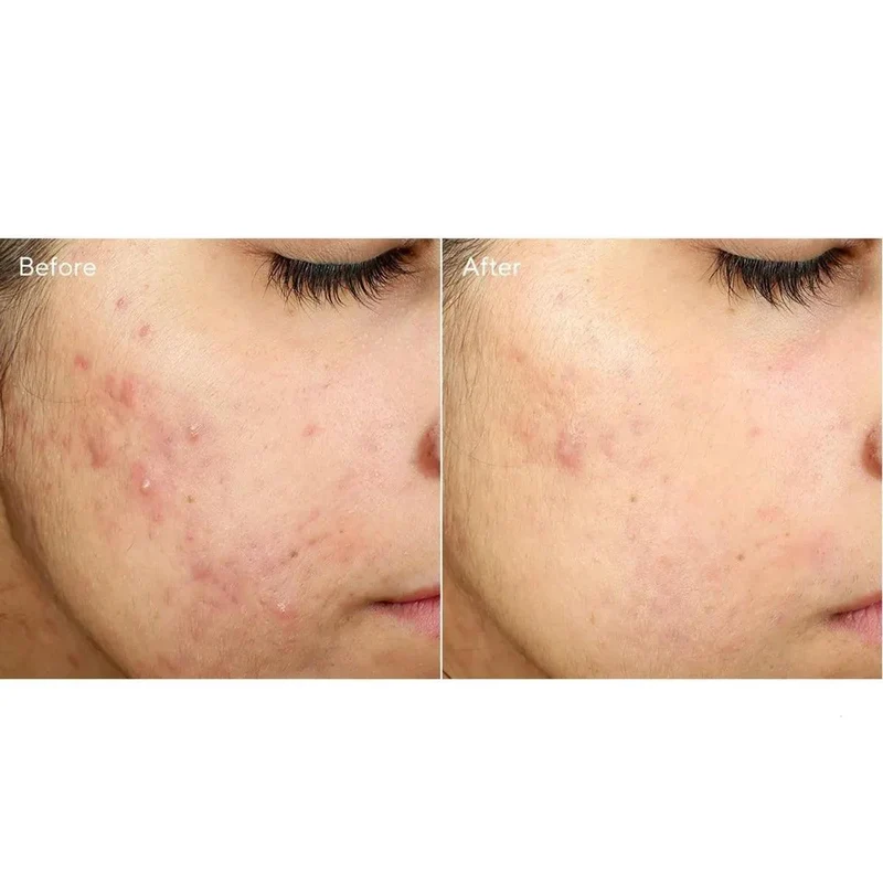 Murad Invisiscar Resurfacing Treatment crema acne 15ml