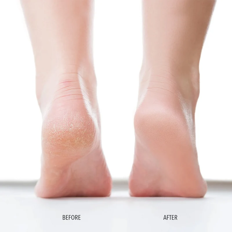 LondonTown Kur Pedikur Foot Scrub 118ml - esfoliante per piedi