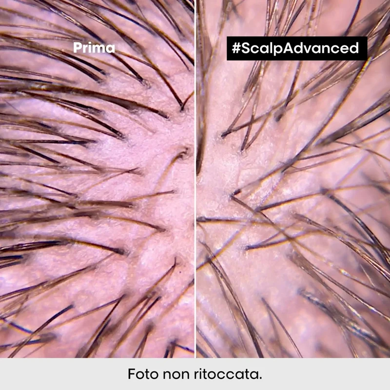 L'Oreal Trattamento Lenitivo Intense Soother – Scalp Advanced 200 ml