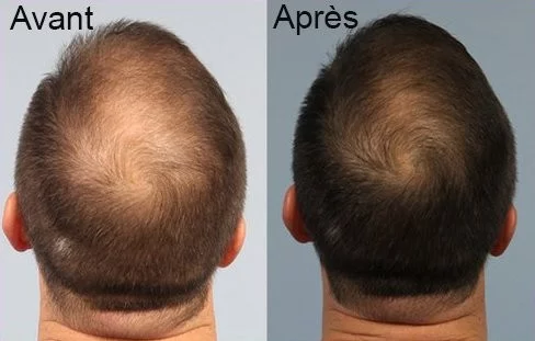 Men - Cure 3 mois