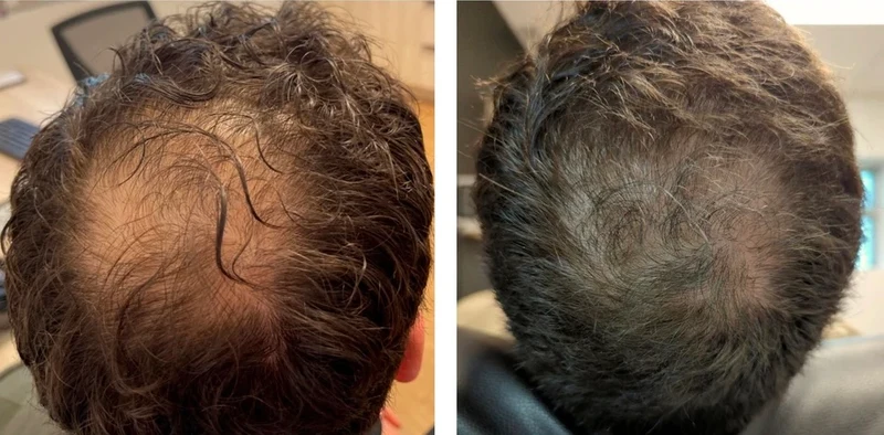 Men - Cure 3 mois
