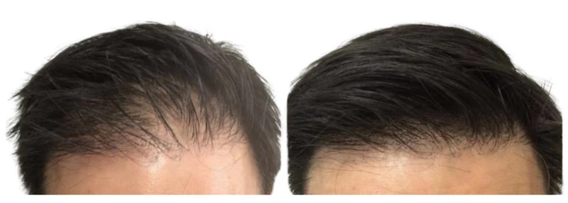 Men - Cure 3 mois