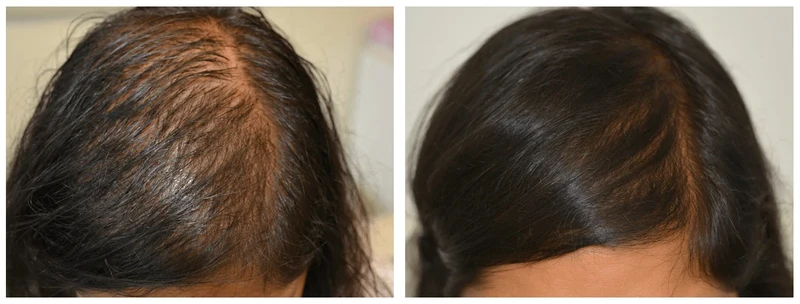 CapilActive Women - Fortifiant cheveux